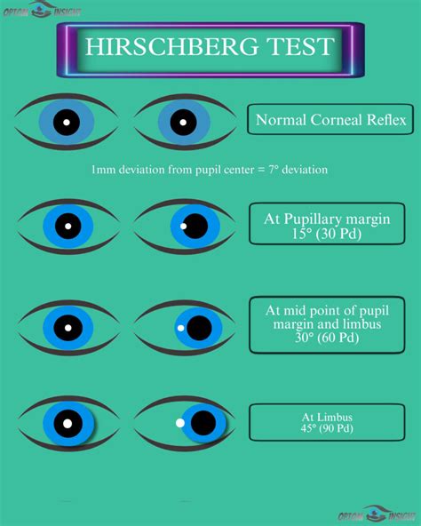 Hirschberg Corneal Reflex Test .
